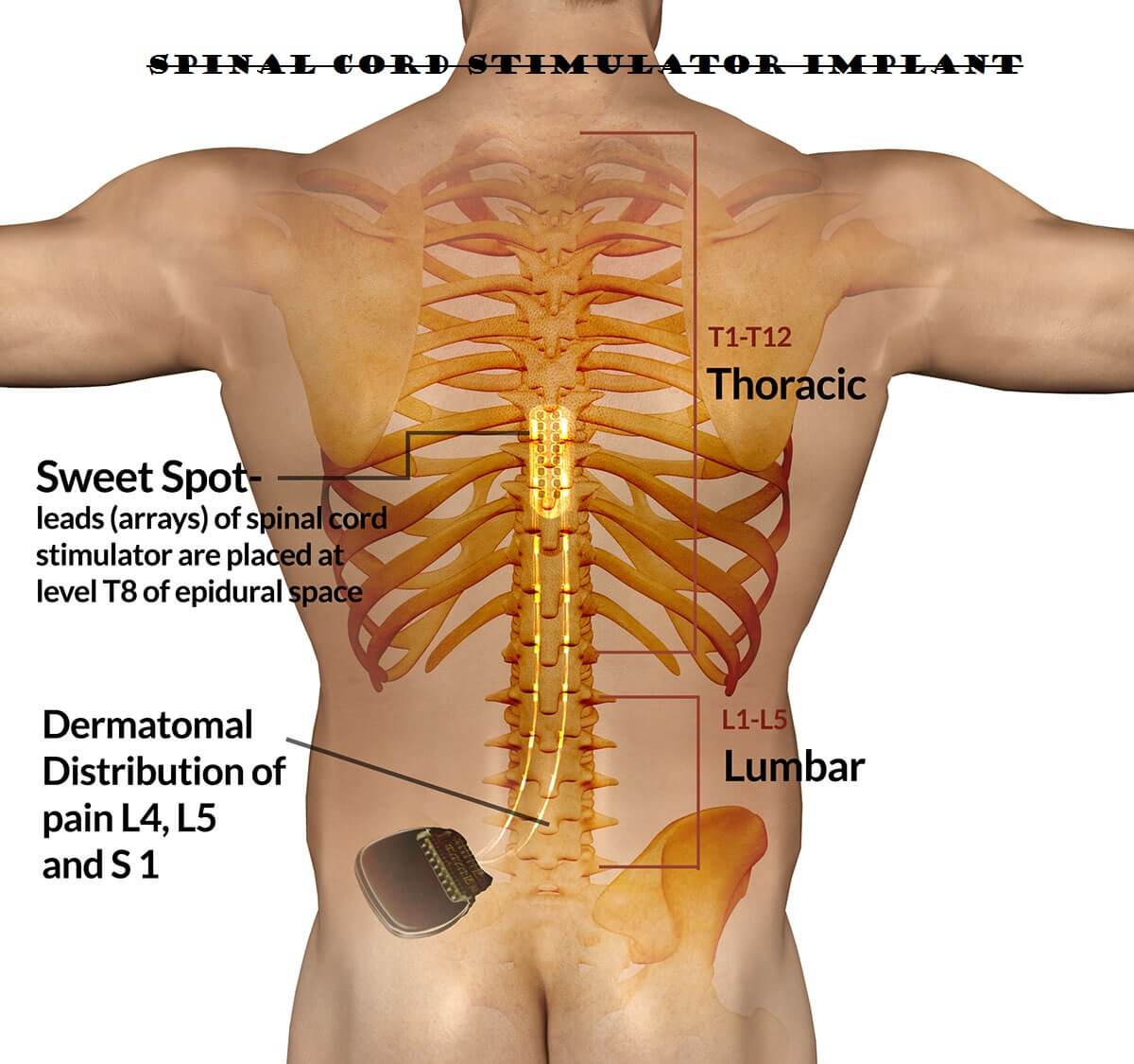 spinal cord dorsal column stimulator