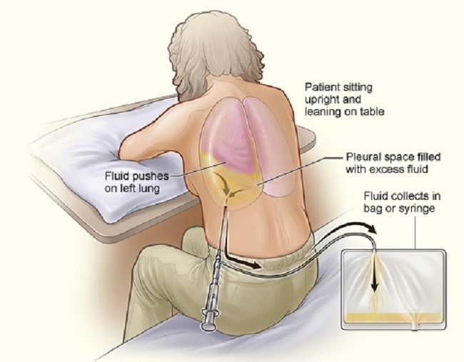 Awesome Things You Can Learn From Flank Pain