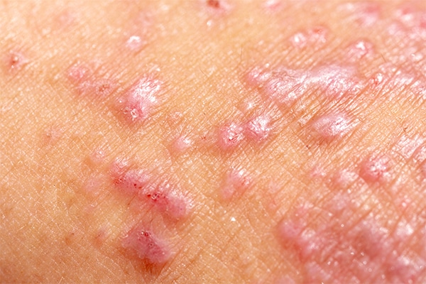 Tips To Help Identify Contact Dermatitis NaturalHealth